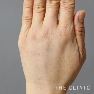 【THE CLINIC 症例画像】No.492_2_手のシワ_手の甲への脂肪注入(ハンドリバイブ)
