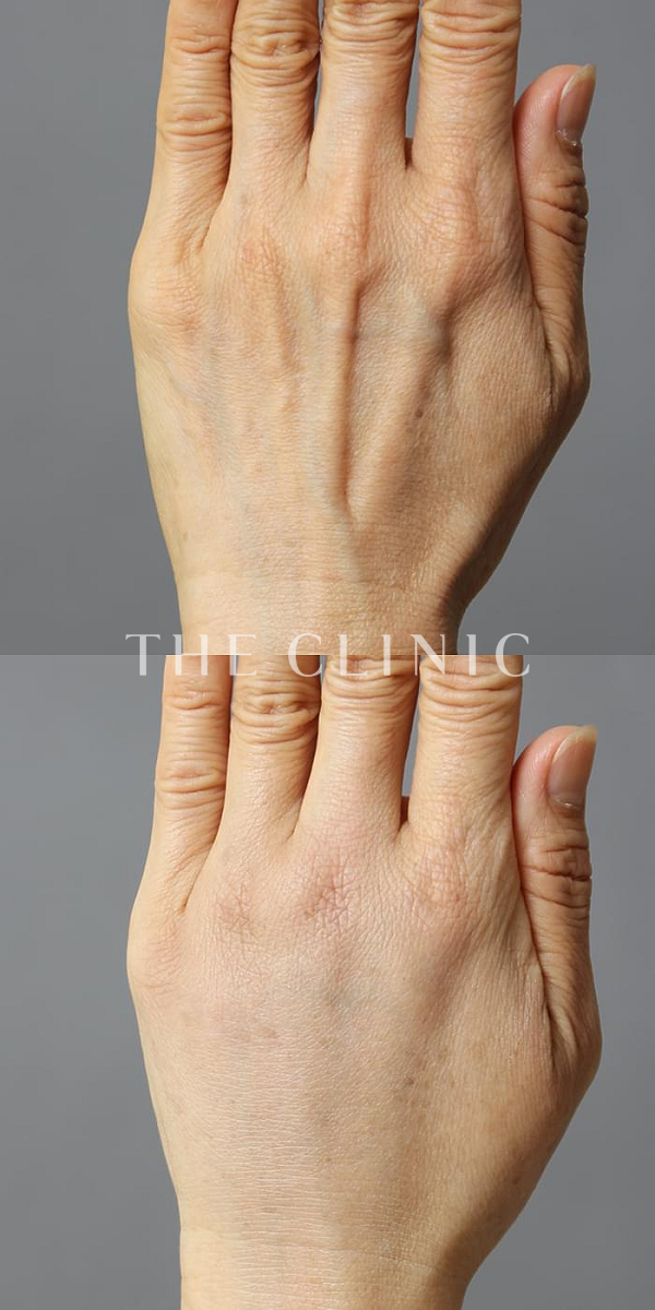 手のシワの手の甲への脂肪注入(ハンドリバイブ)（59歳女性）の術前・術後写真