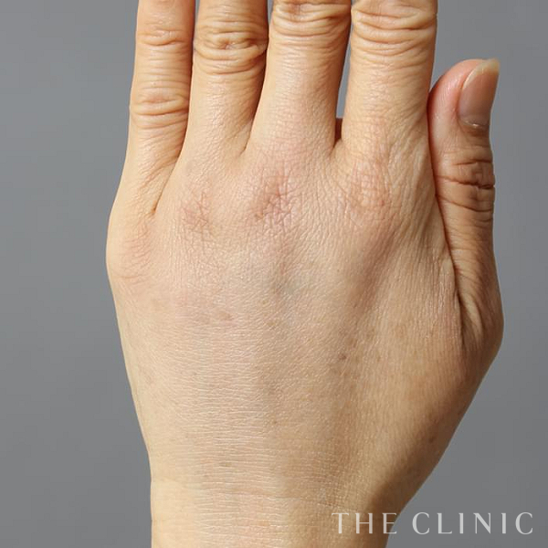 手のシワの手の甲への脂肪注入(ハンドリバイブ)（59歳女性）の術後写真