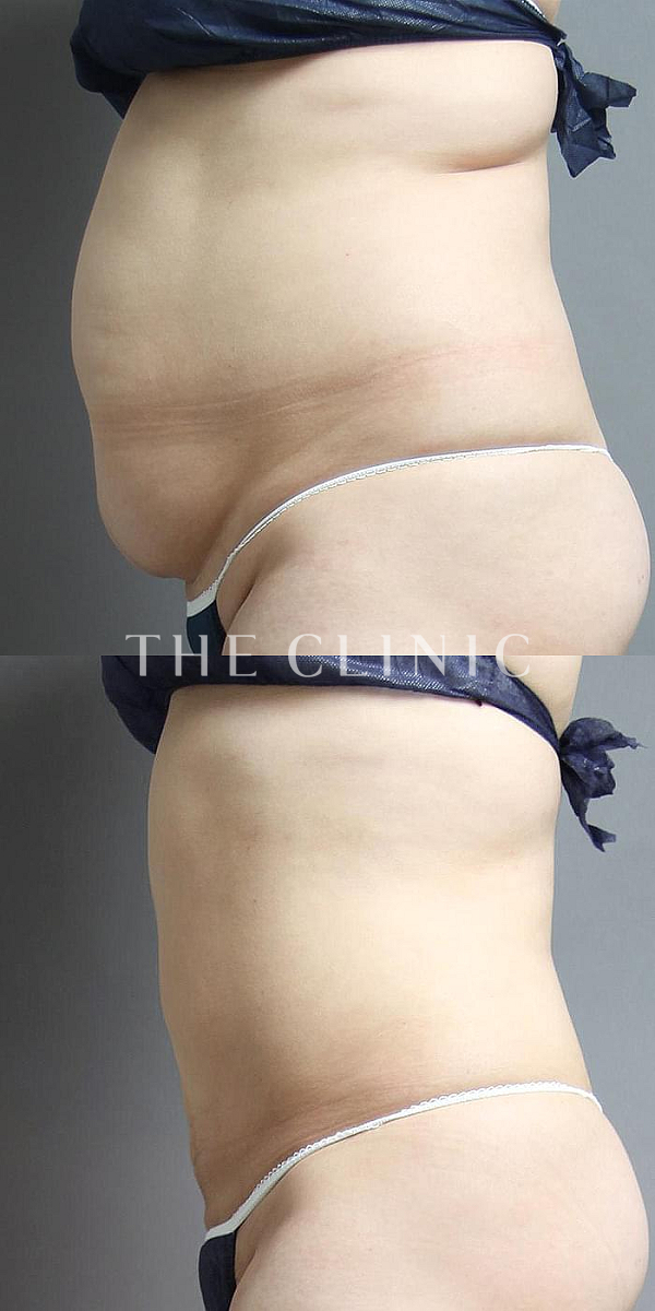 腹部のベイザー脂肪吸引（34歳女性）の術前・術後写真