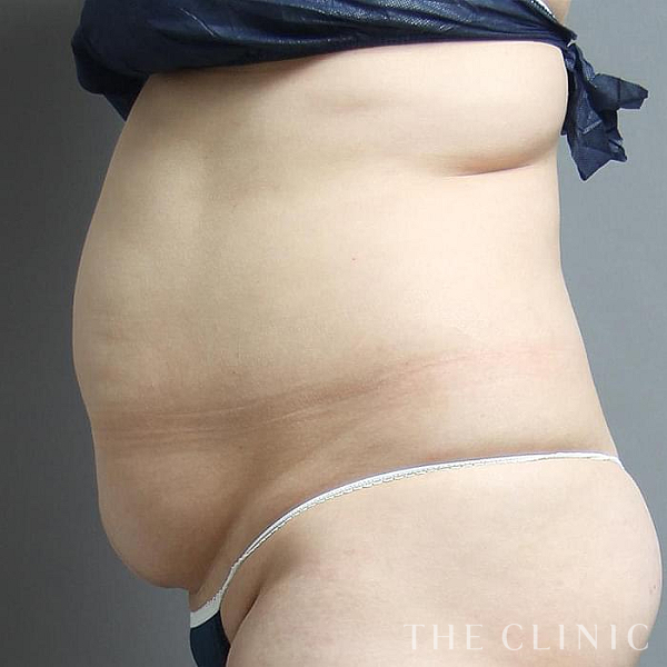 腹部のベイザー脂肪吸引（34歳女性）の術前写真