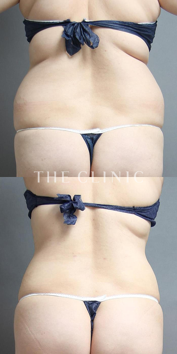 背中のベイザー脂肪吸引（34歳女性）の術前・術後写真