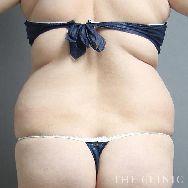 背中のベイザー脂肪吸引（34歳女性）の術前写真