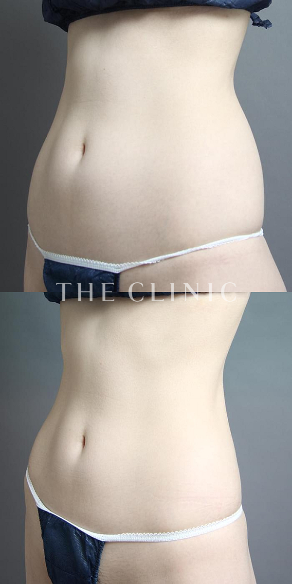 腰・ウエストのベイザー脂肪吸引（26歳女性）の術前・術後写真