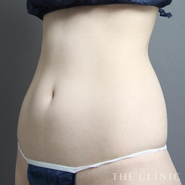 腰・ウエストのベイザー脂肪吸引（26歳女性）の術前写真