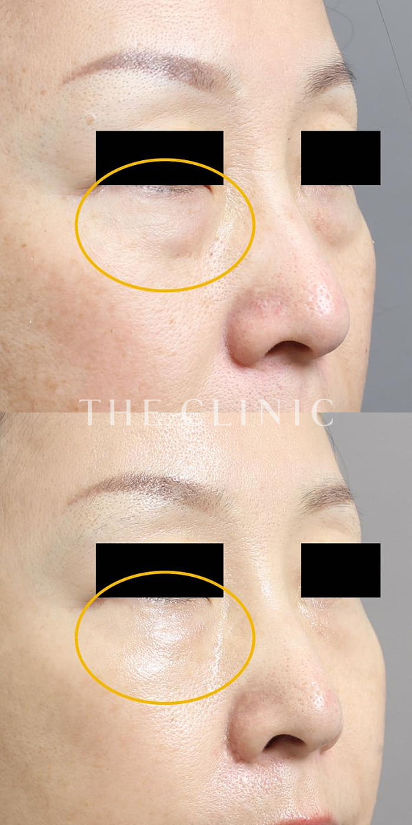 目の下のクマのマイクロCRF注入(顔の脂肪注入)（43歳女性）の術前・術後写真