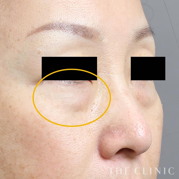 目の下のクマのマイクロCRF注入(顔の脂肪注入)（43歳女性）の術前写真