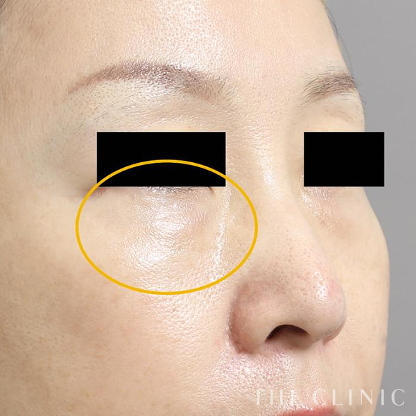 目の下のクマのマイクロCRF注入(顔の脂肪注入)（43歳女性）の術後写真