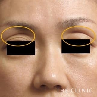 【THE CLINIC 症例画像】No.502_1_目の上のくぼみ_マイクロCRF注入(顔の脂肪注入)