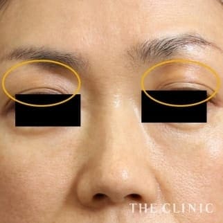 【THE CLINIC 症例画像】No.502_2_目の上のくぼみ_マイクロCRF注入(顔の脂肪注入)