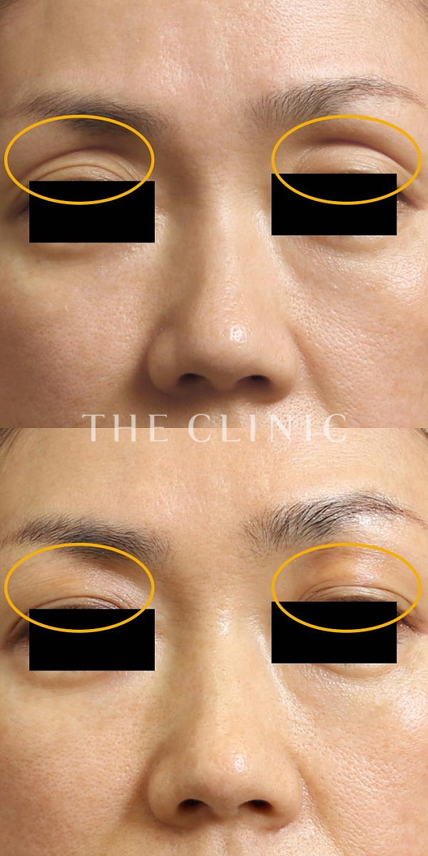 目の上のくぼみのマイクロCRF注入(顔の脂肪注入)（45歳女性）の術前・術後写真