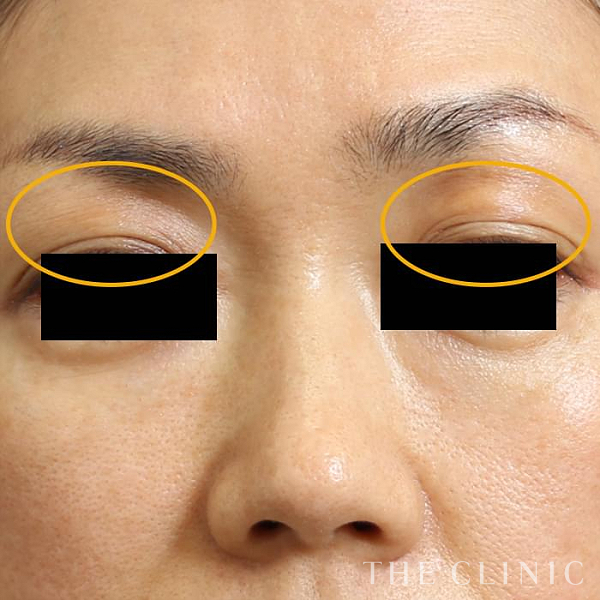 目の上のくぼみのマイクロCRF注入(顔の脂肪注入)（45歳女性）の術後写真