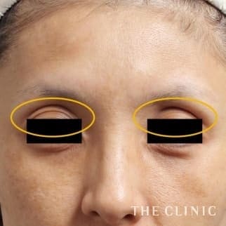 【THE CLINIC 症例画像】No.503_1_目の上のくぼみ_マイクロCRF注入(顔の脂肪注入)