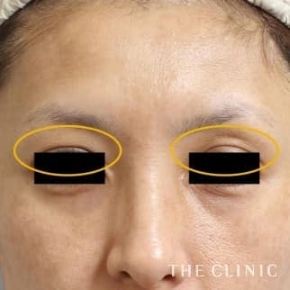 【THE CLINIC 症例画像】No.503_2_目の上のくぼみ_マイクロCRF注入(顔の脂肪注入)