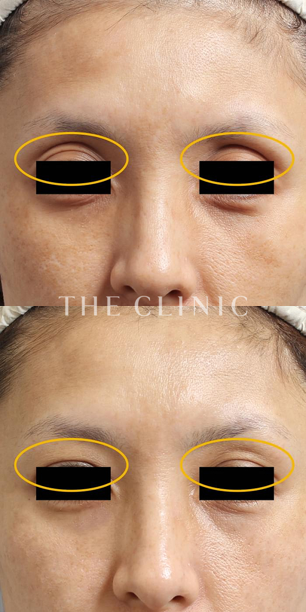 目の上のくぼみのマイクロCRF注入(顔の脂肪注入)（40歳女性）の術前・術後写真