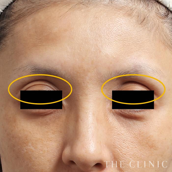 目の上のくぼみのマイクロCRF注入(顔の脂肪注入)（40歳女性）の術前写真