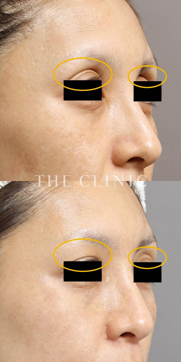 目の上のくぼみのマイクロCRF注入(顔の脂肪注入)（40歳女性）の術前・術後写真