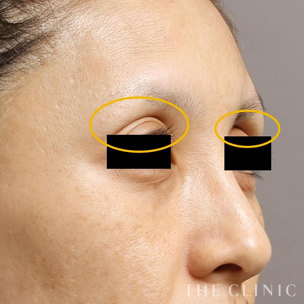 目の上のくぼみのマイクロCRF注入(顔の脂肪注入)（40歳女性）の術前写真