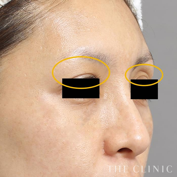 目の上のくぼみのマイクロCRF注入(顔の脂肪注入)（40歳女性）の術後写真