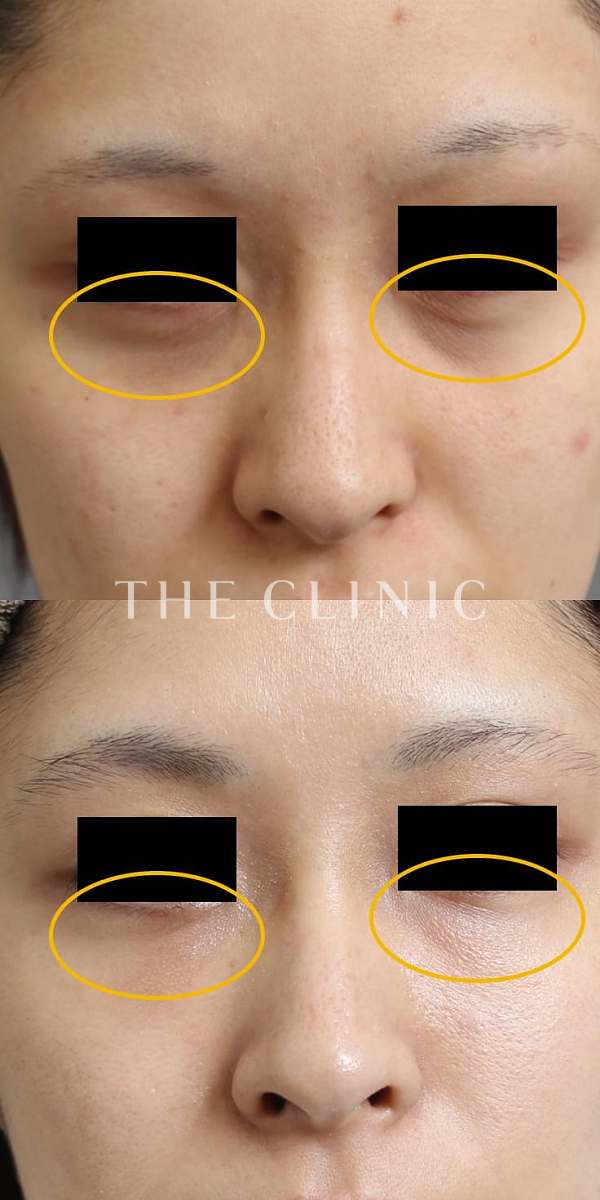 目の下のクマのマイクロCRF注入(顔の脂肪注入)（22歳女性）の術前・術後写真