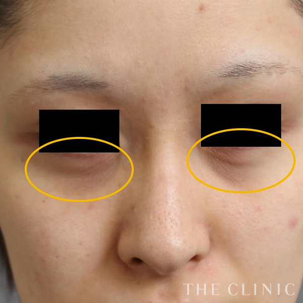 目の下のクマのマイクロCRF注入(顔の脂肪注入)（22歳女性）の術前写真