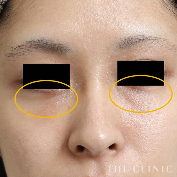 目の下のクマのマイクロCRF注入(顔の脂肪注入)（22歳女性）の術後写真