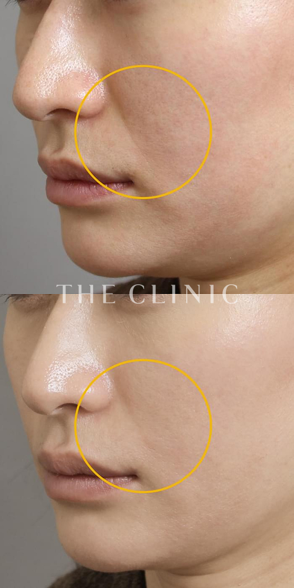 法令線のマイクロCRF注入(顔の脂肪注入)（37歳女性）の術前・術後写真