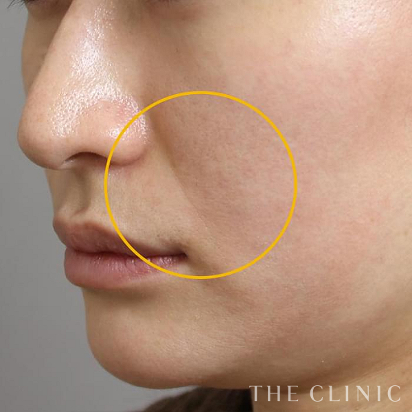 法令線のマイクロCRF注入(顔の脂肪注入)（37歳女性）の術前写真