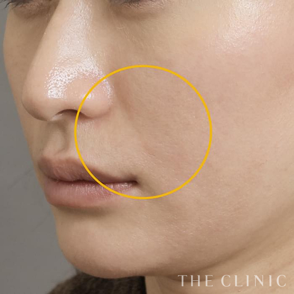 法令線のマイクロCRF注入(顔の脂肪注入)（37歳女性）の術後写真