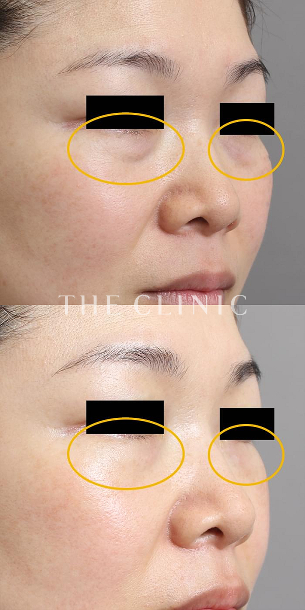 目の下のクマのマイクロCRF注入(顔の脂肪注入)（46歳女性）の術前・術後写真