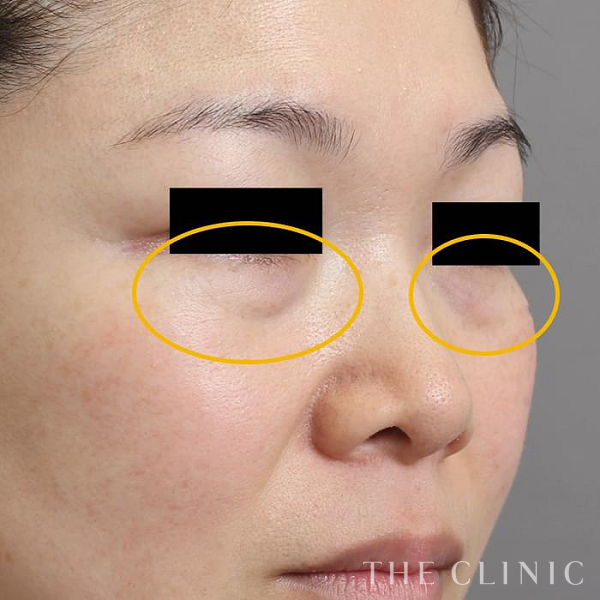 目の下のクマのマイクロCRF注入(顔の脂肪注入)（46歳女性）の術前写真