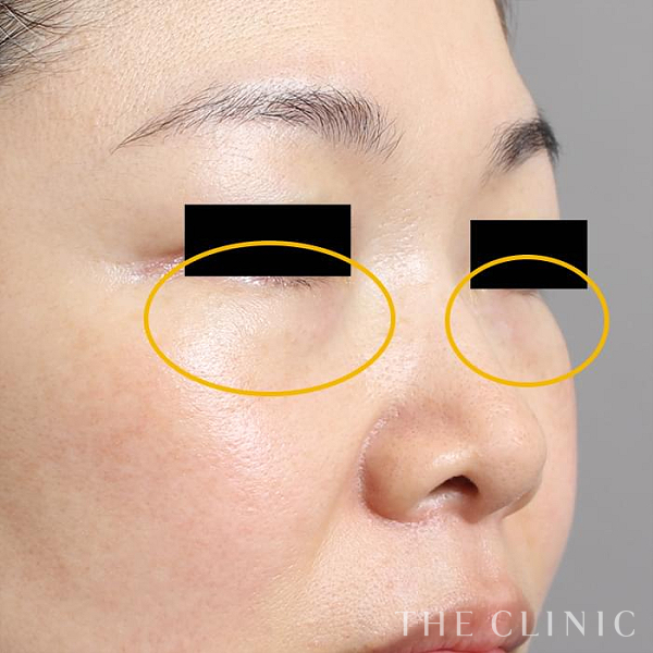 目の下のクマのマイクロCRF注入(顔の脂肪注入)（46歳女性）の術後写真