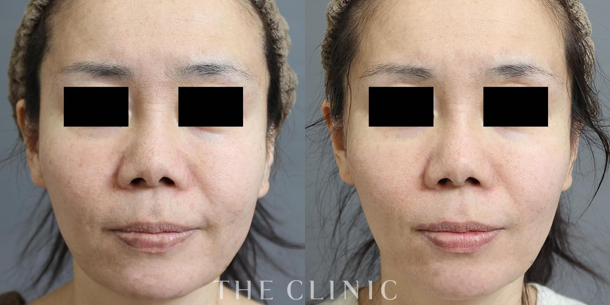 ベイザー脂肪吸引の術前／術後