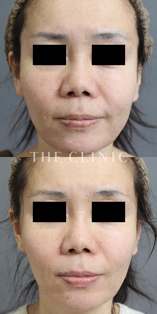 頰／顎のベイザー脂肪吸引（47歳女性）の術前・術後写真