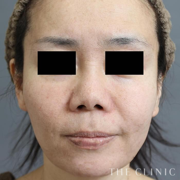 頰／顎のベイザー脂肪吸引（47歳女性）の術前写真