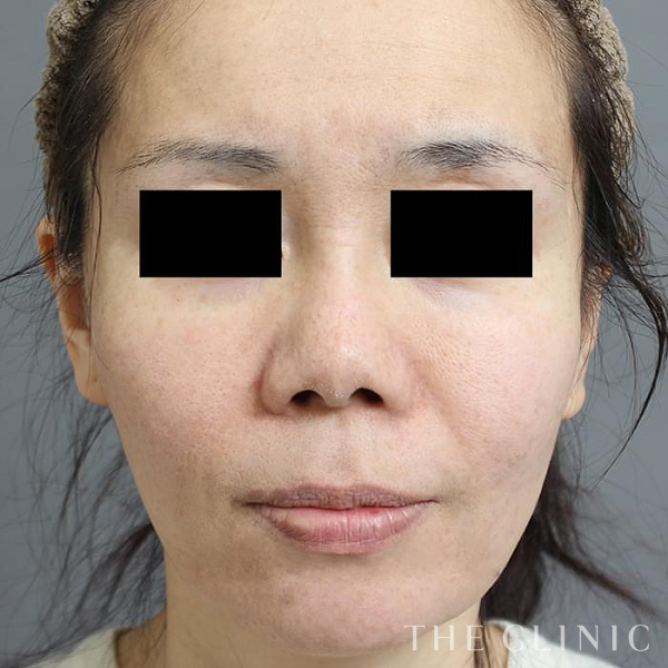 頰／顎のベイザー脂肪吸引（47歳女性）の術後写真