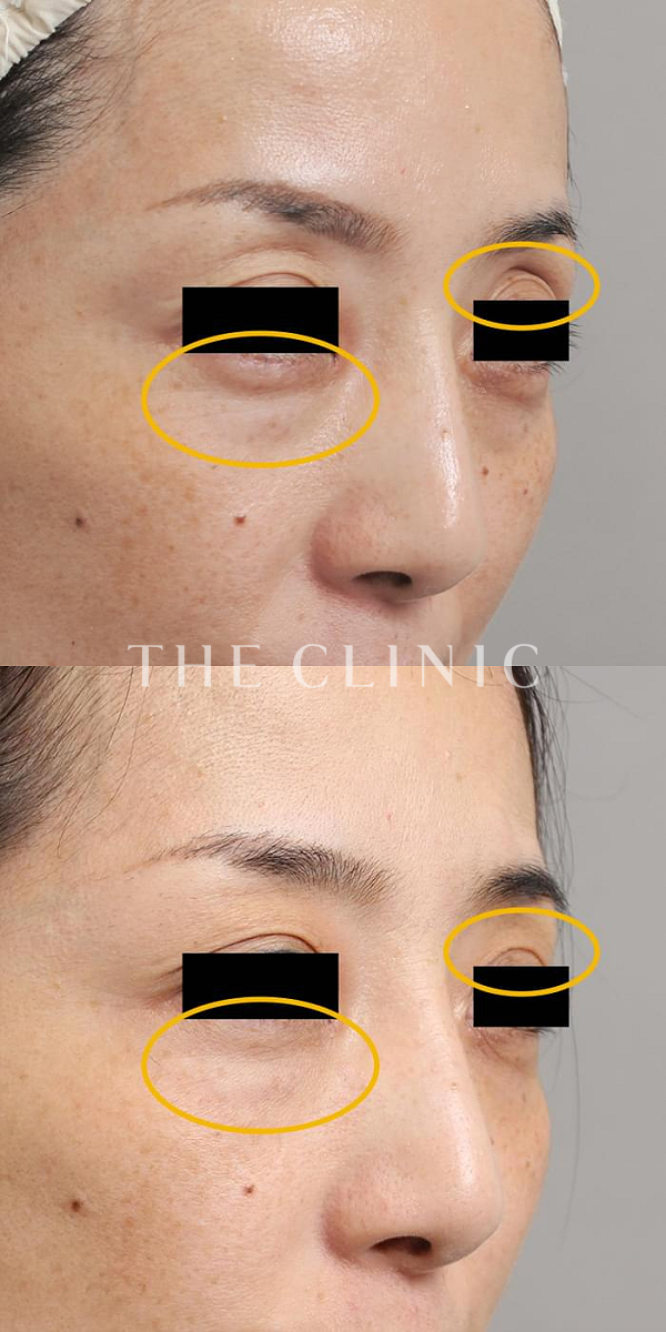 目の上のくぼみ・目の下のクマのマイクロCRF注入(顔の脂肪注入)（45歳女性）の術前・術後写真