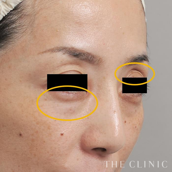 目の上のくぼみ・目の下のクマのマイクロCRF注入(顔の脂肪注入)（45歳女性）の術前写真