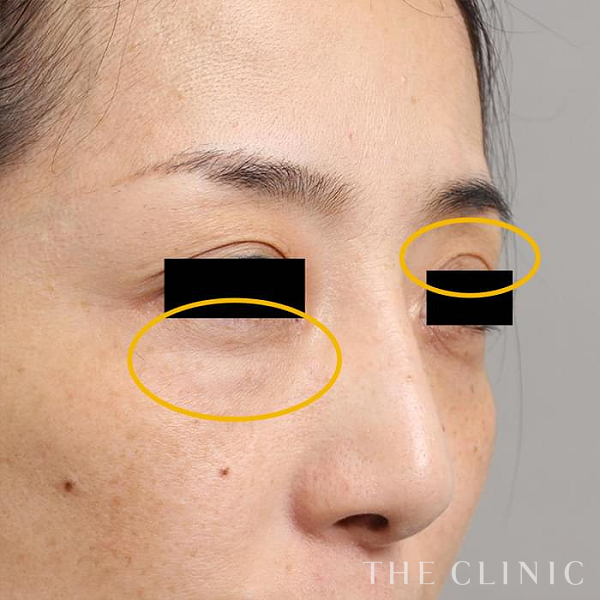 目の上のくぼみ・目の下のクマのマイクロCRF注入(顔の脂肪注入)（45歳女性）の術後写真