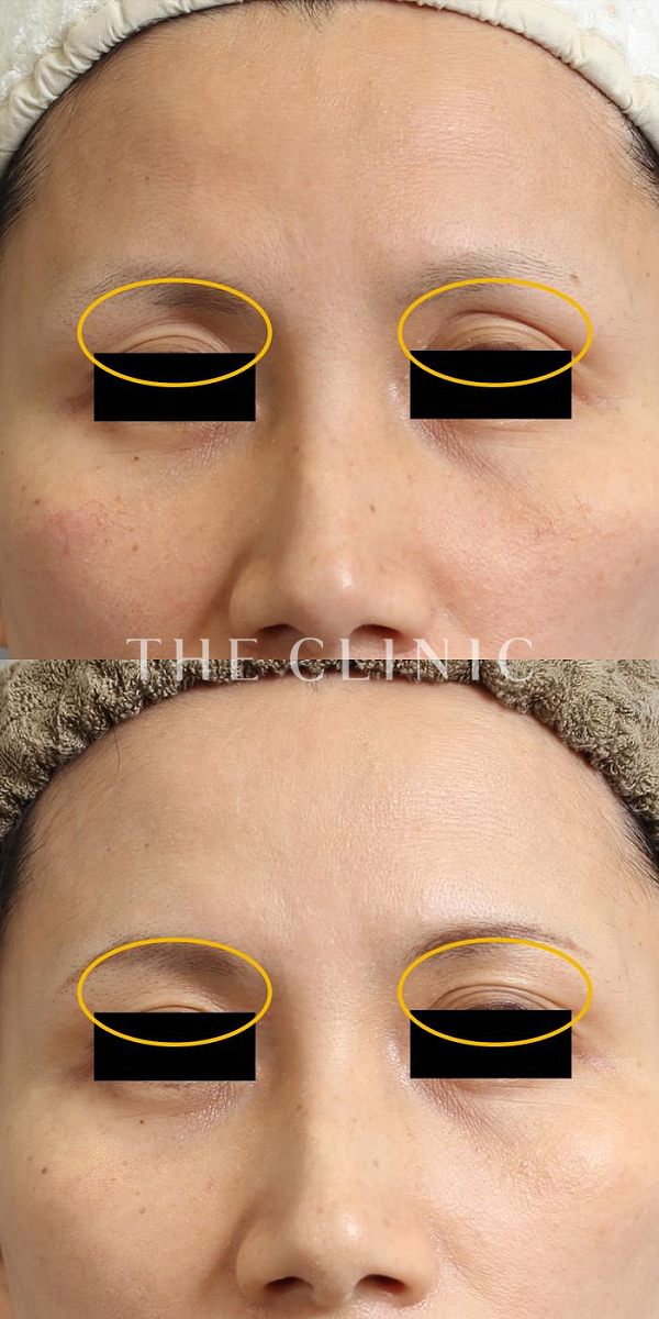 目の上のくぼみのマイクロCRF注入(顔の脂肪注入)（42歳女性）の術前・術後写真