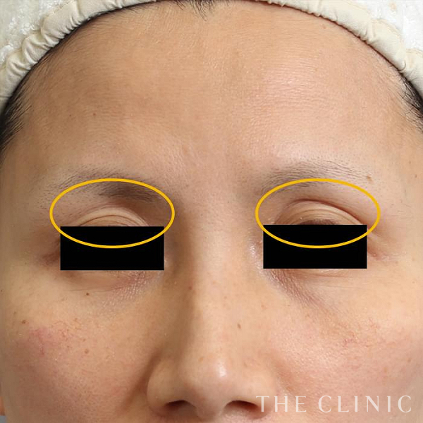 目の上のくぼみのマイクロCRF注入(顔の脂肪注入)（42歳女性）の術前写真