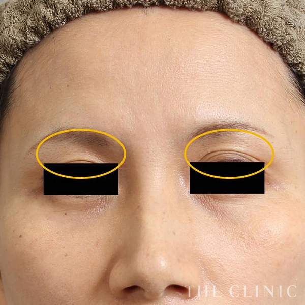 目の上のくぼみのマイクロCRF注入(顔の脂肪注入)（42歳女性）の術後写真