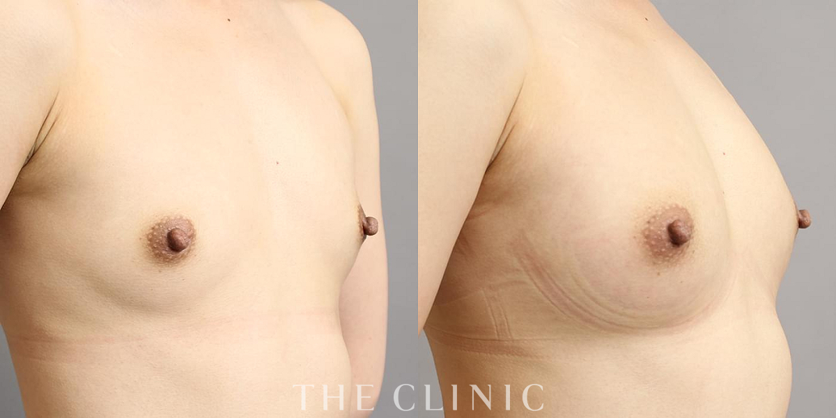 コンデンスリッチ豊胸の術前/術後