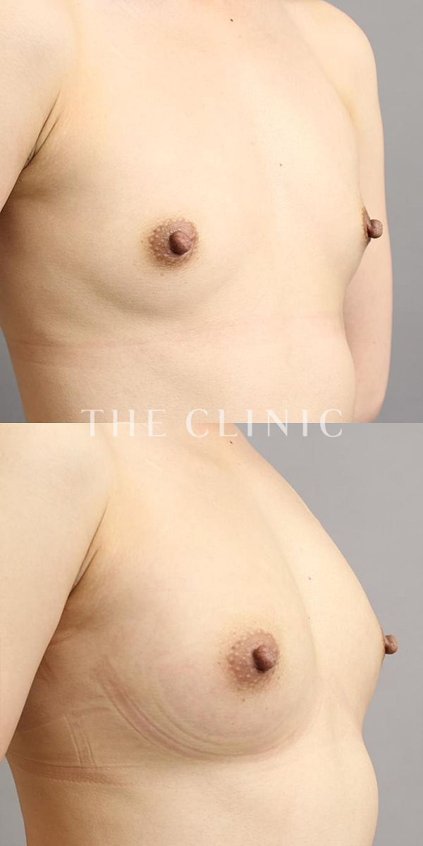 ボリュームアップのコンデンスリッチ豊胸（29歳女性）の術前・術後写真