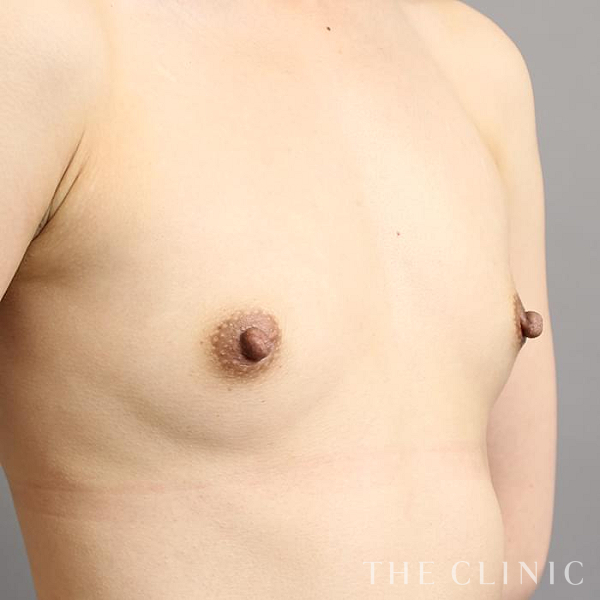 ボリュームアップのコンデンスリッチ豊胸（29歳女性）の術前写真