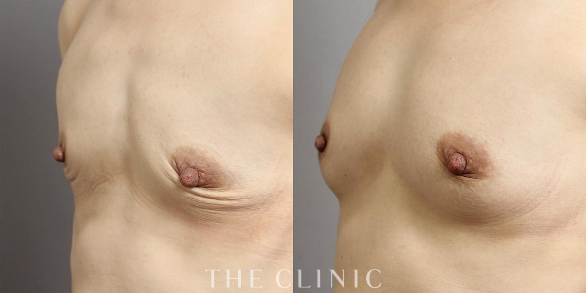 コンデンスリッチ豊胸の術前/術後