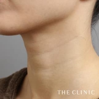 【THE CLINIC 症例画像】No.519_1_首のシワ_マイクロCRF注入(顔の脂肪注入)