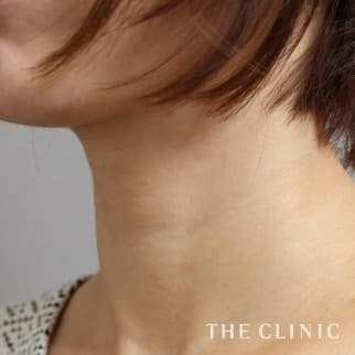 【THE CLINIC 症例画像】No.519_2_首のシワ_マイクロCRF注入(顔の脂肪注入)