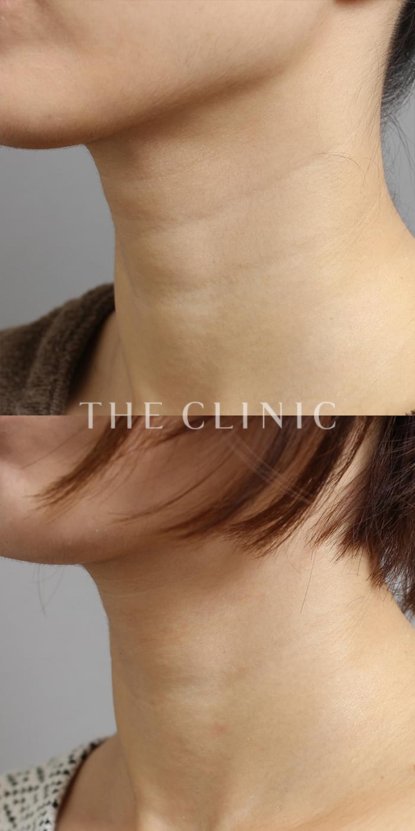 首のシワのマイクロCRF注入(顔の脂肪注入)（36歳女性）の術前・術後写真