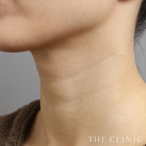 首のシワのマイクロCRF注入(顔の脂肪注入)（36歳女性）の術前写真